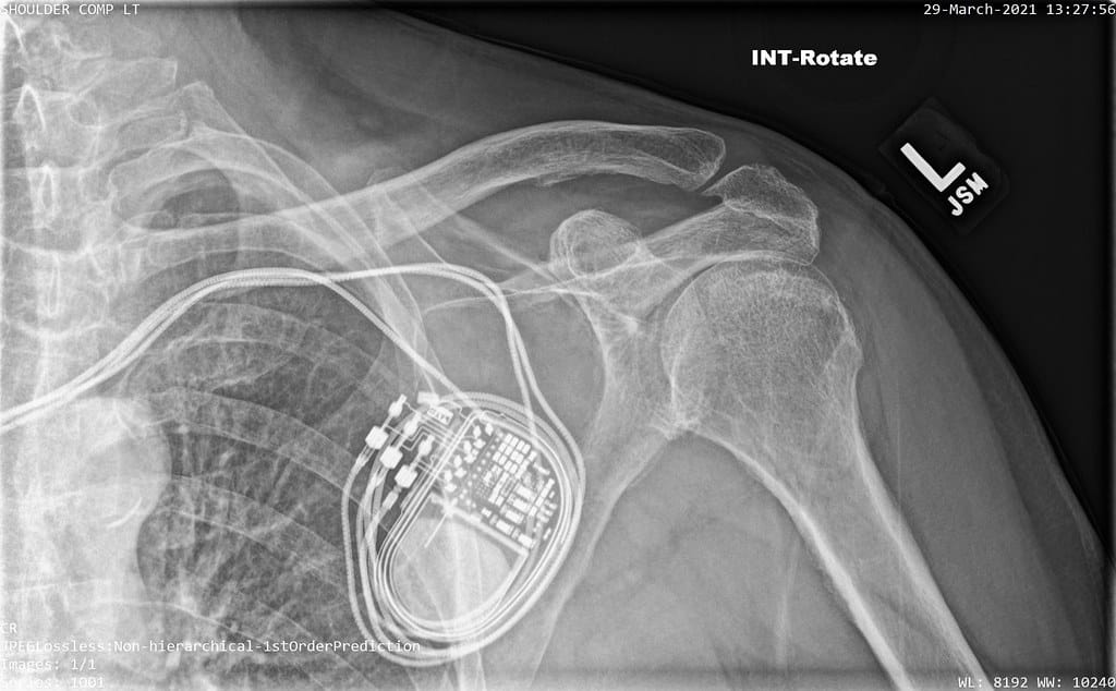 Throwback Thursday - Pacemaker
