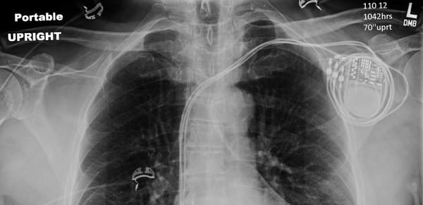 Cardiac Catheterization
