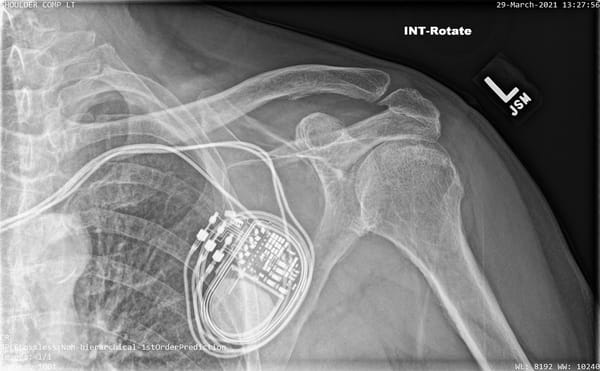 Throwback Thursday - Pacemaker